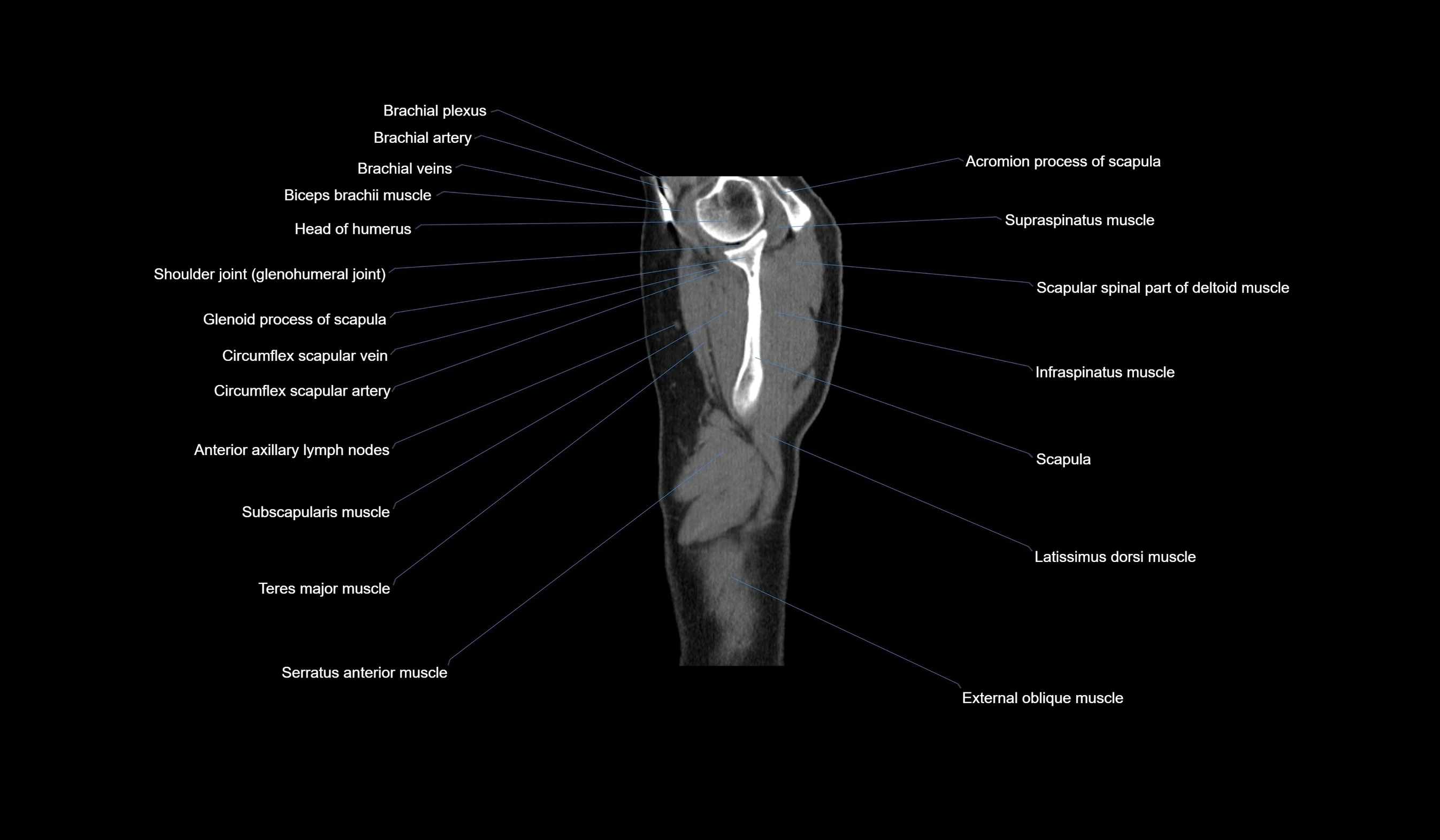 CT chest (thorax) soft tissue window labelled sagittal cross sectional anatomy radiology image-00009.webp